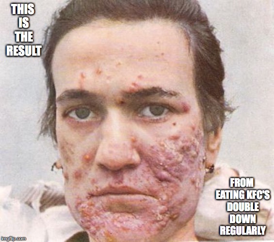 Acne | THIS IS THE RESULT; FROM EATING KFC'S DOUBLE DOWN REGULARLY | image tagged in acne,kfc,double down,memes | made w/ Imgflip meme maker