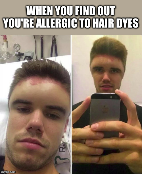 Allergies | WHEN YOU FIND OUT YOU'RE ALLERGIC TO HAIR DYES | image tagged in allergies,allergy,hair dye,funny meme | made w/ Imgflip meme maker