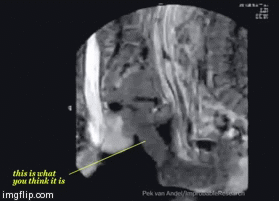 Sex Seen Through MRI Machine Imgflip
