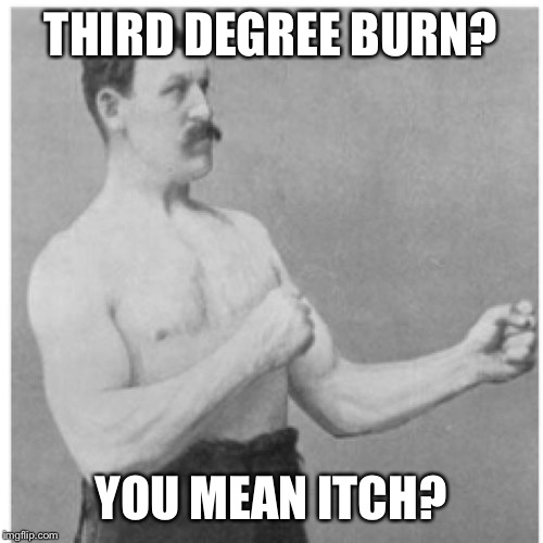 Overly Manly Man |  THIRD DEGREE BURN? YOU MEAN ITCH? | image tagged in memes,overly manly man | made w/ Imgflip meme maker