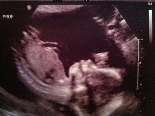 Fetus Cat Ultrasound Blank Meme Template
