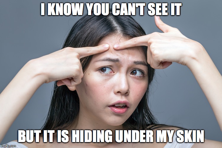 Can You See My Pimple? |  I KNOW YOU CAN'T SEE IT; BUT IT IS HIDING UNDER MY SKIN | image tagged in pimple,zit,acne,pop | made w/ Imgflip meme maker