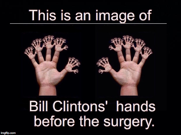 Black background | This is an image of; Bill Clintons'  hands before the surgery. | image tagged in black background | made w/ Imgflip meme maker