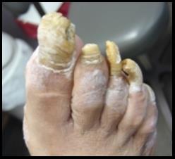 Ugly Toe Nails Blank Meme Template