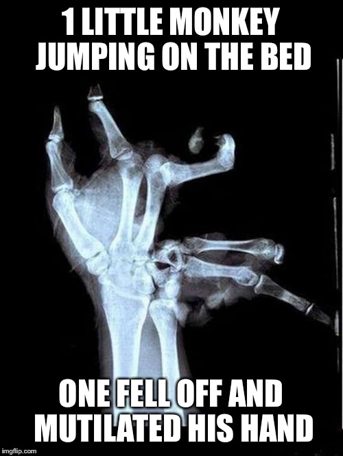 Broken Hand | 1 LITTLE MONKEY JUMPING ON THE BED; ONE FELL OFF AND MUTILATED HIS HAND | image tagged in broken hand | made w/ Imgflip meme maker