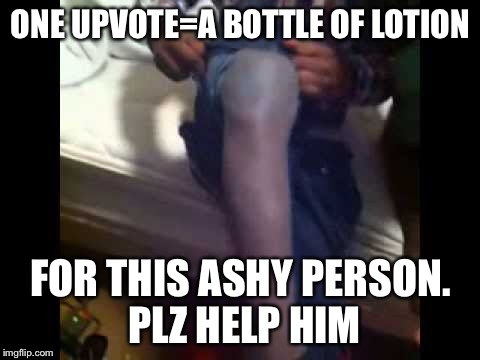 ONE UPVOTE=A BOTTLE OF LOTION; FOR THIS ASHY PERSON. PLZ HELP HIM | image tagged in too much ash,black lives matter | made w/ Imgflip meme maker
