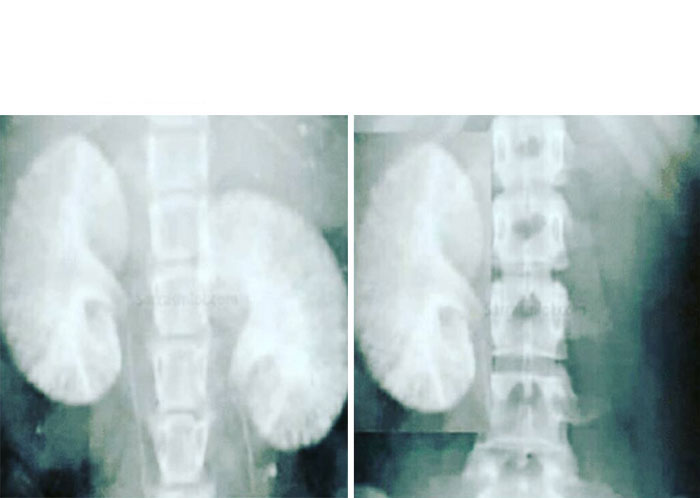 kidney x-ray before after Blank Meme Template