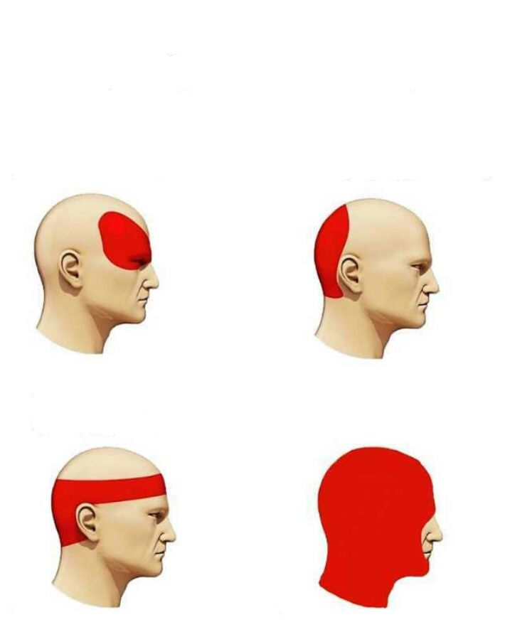 types of headache Blank Meme Template