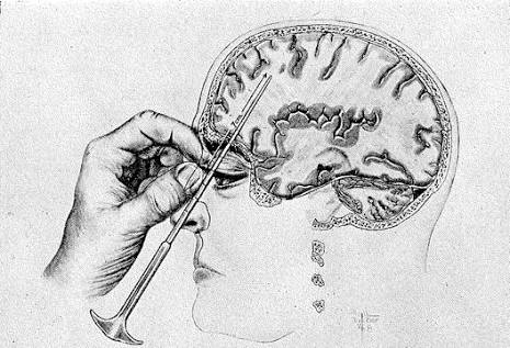 Lobotomy  Blank Meme Template