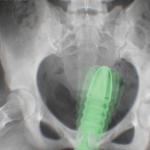 analthema