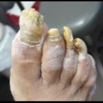 Ugly Toe Nails meme