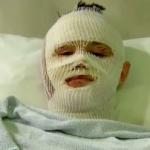 hospital bed survivor burn victim