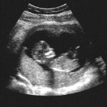 Ultrasound babby