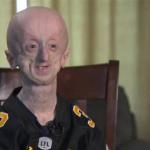 Progeria guy