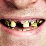 Rotten teeth