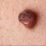 overly attached Wart
