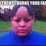Chicken boy | WHEN THE KFC BURNS YOUR FACE OFF | image tagged in ugly hairline,kfc,alah,damn,funny,meme | made w/ Imgflip meme maker