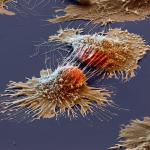 cancer cell under a microscope