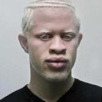 Albino Black guy