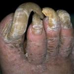 Toenails meme