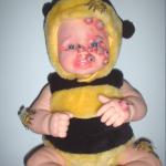 Baby Bee Sting