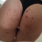 Ass rash