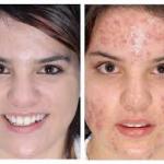 BEFORE AND AFTER ACNE MEME - Imgflip