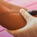 Needle in arm