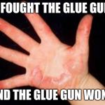 Burned Hands | I FOUGHT THE GLUE GUN; AND THE GLUE GUN WON... | image tagged in burned hands | made w/ Imgflip meme maker