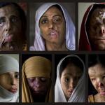 Acid attack victims