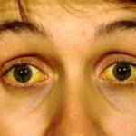 Jaundice meme