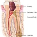 Root Canal Therapy - Mosmandentalclinic.com.au