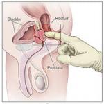 prostAte