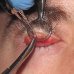 Sty removal