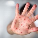 Child's hand with measles - thank you anti-vaxxers meme