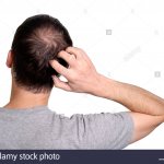 Man Scratching Back Of Head