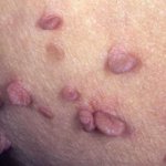 Anal Herpes, ass lesions