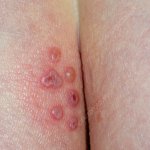 Anal Herpes  - Ass lesions