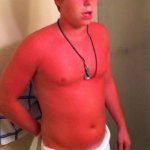 Extreme sunburn