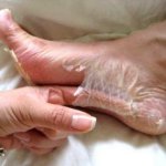 foot skin peel shedding