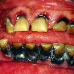 rotten teeth