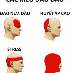 Types Of Headache - Vietsub