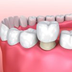 tooth crown dentist