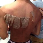 Back skin peeling