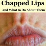 10 causes of chapped lips