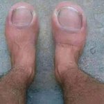 Toe foot