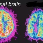 Normal brain vs mentally ill brain