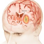 Brain tumour template