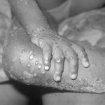 MONKEYPOX 4YO GIRL