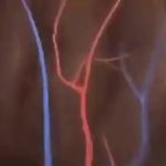 Brain aneurysm GIF Template